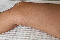 Close-up of a leg showing visible varicose veins and capillaries on tanned skin. The background is a textured white surface [IBR125237473]