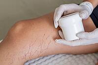 A close-up of a leg with visible varicose veins and capillaries. A gloved hand holds a small white container, indicating a treatment process [IBR125237476]
