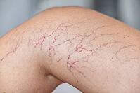 Close-up of a tanned leg showing visible varicose veins and capillaries. The skin appears smooth with a few dark lines indicating vascular issues [IBR125237477]