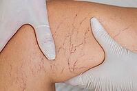 Close-up of a leg showing varicose veins and capillaries. A gloved hand examines the skin, highlighting the vascular condition [IBR125237481]