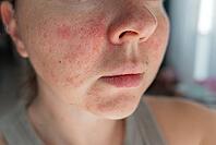 Close-up of a young womans face with visible skin irritation and redness. Inflamed, dry, and textured skin. Concept of sensitive skin, allergy, inflammation, and skincare problems [IBR125237483]
