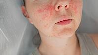 Close-up young woman with visible facial skin redness, irritation, and inflamed texture. Concept of skincare problems and dermatology treatment. Natural skin imperfections, beauty, and healthcare [IBR125237484]