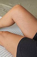 Close-up of a leg showing visible varicose veins and capillaries. The skin is tan with fine hair. The person is wearing black shorts, lying on a textured surface [IBR125237487]