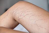 Close-up of a tanned leg showing visible varicose veins and capillaries. The skin appears smooth with a few dark lines indicating vascular issues [IBR125237488]