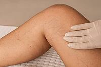 Close-up of a knee with visible varicose veins and capillaries. A gloved hand gently touches the skin, highlighting vascular issues [IBR125237490]