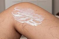 A close-up of a knee with visible varicose veins and capillaries. A white cream is applied to the skin, highlighting the vascular condition [IBR125237492]