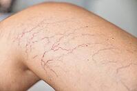 Close-up of lower leg with spider veins and superficial telangiectasia. Visible vascular changes associated with chronic venous disease, phlebology, vascular diagnostics, prevention, and medical healt [IBR125237497]