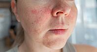 Close-up young womans face with visible skin redness, irritation, and uneven texture. Signs of allergic reaction, acne, or dry sensitive skin with inflammation, flaking, and discomfort [IBR125237499]