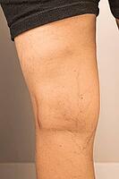 Close-up of a human leg showing visible varicose veins and capillaries. The skin is light brown with a smooth texture. The person is wearing black shorts [IBR125237500]