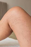 Close-up of a human leg showing visible varicose veins and capillaries. The skin appears light brown with a smooth texture. The knee is slightly bent [IBR125237502]