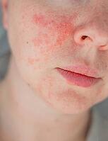 Close-up young woman cheek with visible acne, redness, and irritation. Concept of skin allergy, acne, dermatology, sensitive skin, and facial care problems [IBR125237503]