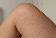 Close-up of a human leg showing varicose veins and capillaries. The skin is light brown with visible purple and blue veins on the thigh area [IBR125237509]