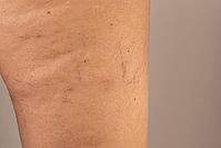 Close-up of a human leg showing varicose veins and capillaries. The skin is light brown with visible blue and purple veins. The image highlights vascular health issues [IBR125237510]