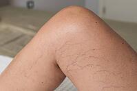 Close-up of a tanned leg showing visible varicose veins and capillaries. The skin appears smooth with a few dark lines indicating vascular issues [IBR125237513]