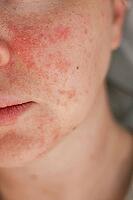 Woman no make up with red spots on her face. Health problem, skin diseases. Medicine and cosmetology concept. [IBR125237514]