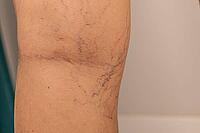 Close-up of a human leg showing varicose veins and capillaries. The skin is light brown with visible blue and purple veins. The image highlights vascular health issues [IBR125237515]