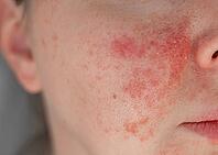Close-up of a young womans face with visible skin irritation and redness. Inflamed, dry, and textured skin. Concept of sensitive skin, allergy, inflammation, and skincare problems [IBR125237516]