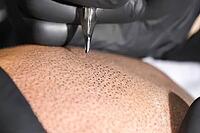 Tattooing with a needle on the scalp in the form of shaved hair. Permanent makeup for bald people to imitate hair follicles. Black medical gloves on a tattoo artist [IBR125242412]