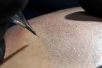 Tattooing with a needle on the scalp in the form of shaved hair. Permanent makeup for bald people to imitate hair follicles. Black medical gloves on a tattoo artist [IBR125242429]