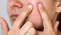 Close up of young woman pressing fingers to red irritated cheek skin, visible inflammation and sensitivity, skincare mock up concept for cosmetic product advertising and dermatology treatment themes [IBR125405003]
