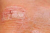 Psoriasis dry red and white irritant on skin close-up. Medical use image [IBR125462062]