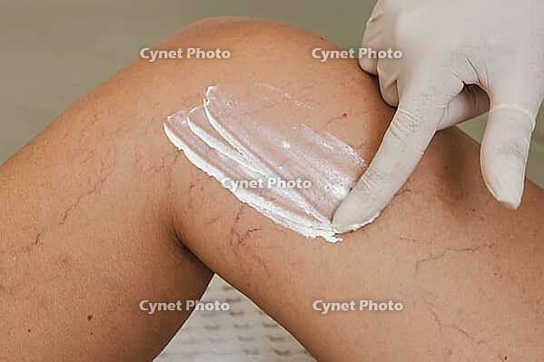 A close-up of a knee with visible varicose veins and capillaries. A gloved hand applies a cream to the skin, focusing on the affected area [IBR125237467]