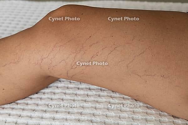 Close-up of a leg showing visible varicose veins and capillaries on tanned skin. The background is a textured white surface [IBR125237473]