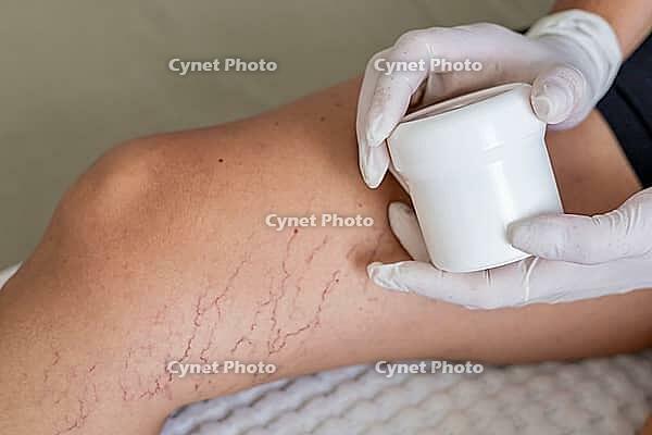 A close-up of a leg with visible varicose veins and capillaries. A gloved hand holds a small white container, indicating a treatment process [IBR125237476]