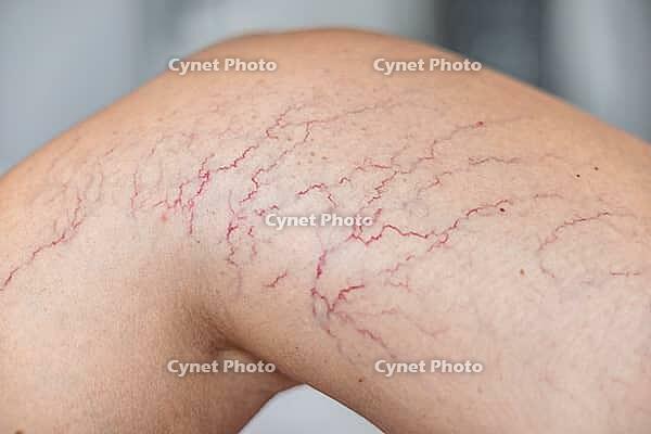 Close-up of a tanned leg showing visible varicose veins and capillaries. The skin appears smooth with a few dark lines indicating vascular issues [IBR125237477]
