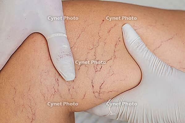 Close-up of a leg showing varicose veins and capillaries. A gloved hand examines the skin, highlighting the vascular condition [IBR125237481]