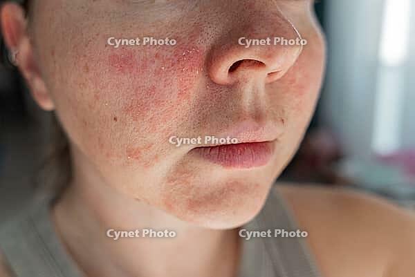 Close-up of a young womans face with visible skin irritation and redness. Inflamed, dry, and textured skin. Concept of sensitive skin, allergy, inflammation, and skincare problems [IBR125237483]