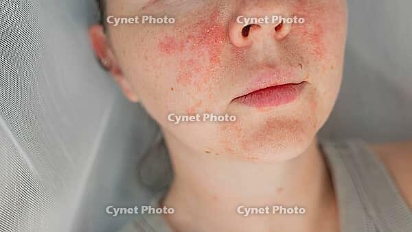 Close-up young woman with visible facial skin redness, irritation, and inflamed texture. Concept of skincare problems and dermatology treatment. Natural skin imperfections, beauty, and healthcare [IBR125237484]