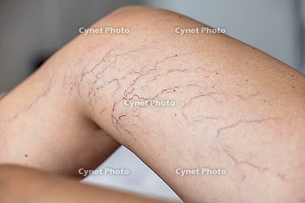 Close-up of a tanned leg showing visible varicose veins and capillaries. The skin appears smooth with a few dark lines indicating vascular issues [IBR125237488]