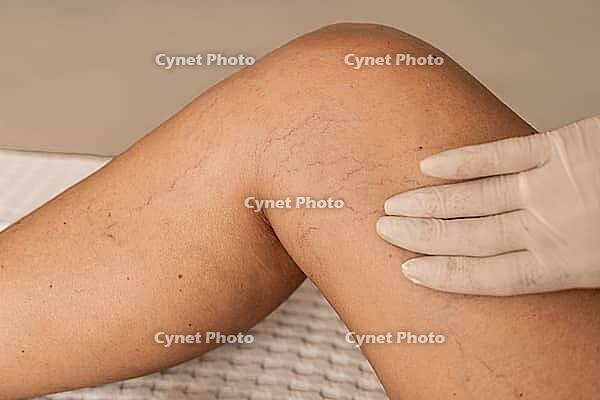 Close-up of a knee with visible varicose veins and capillaries. A gloved hand gently touches the skin, highlighting vascular issues [IBR125237490]