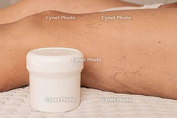Close-up of a leg with visible varicose veins and capillaries. A white cream cream container is placed beside the leg on a textured surface [IBR125237491]