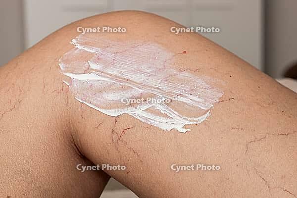 A close-up of a knee with visible varicose veins and capillaries. A white cream is applied to the skin, highlighting the vascular condition [IBR125237492]