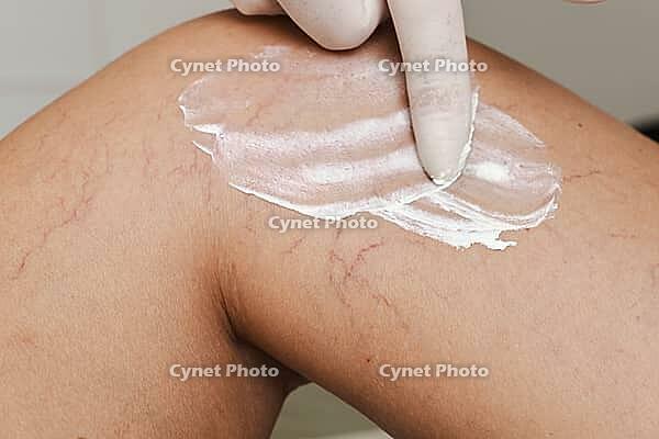 A close-up of a knee with visible varicose veins and capillaries. A gloved hand applies a cream to the skin, focusing on the affected area [IBR125237493]