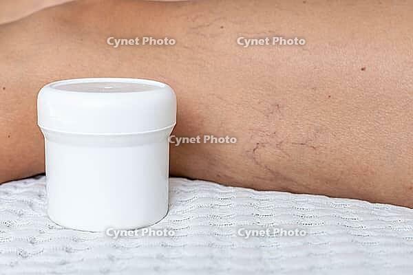 Close-up of a leg with visible varicose veins and capillaries. A white cream container is placed beside the leg on a textured surface [IBR125237496]