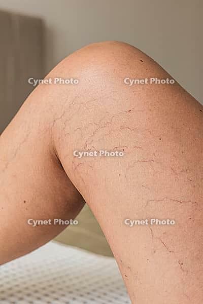 Close-up of a human leg showing visible varicose veins and capillaries. The skin appears light brown with a smooth texture. The knee is slightly bent [IBR125237502]