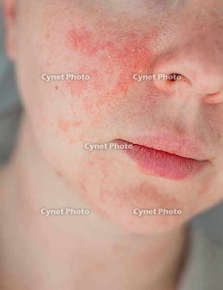 Close-up young woman cheek with visible acne, redness, and irritation. Concept of skin allergy, acne, dermatology, sensitive skin, and facial care problems [IBR125237503]