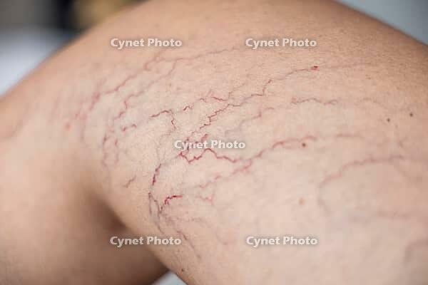 Close-up of a tanned leg showing visible varicose veins and capillaries. The skin appears smooth with a few dark lines indicating vascular issues [IBR125237505]