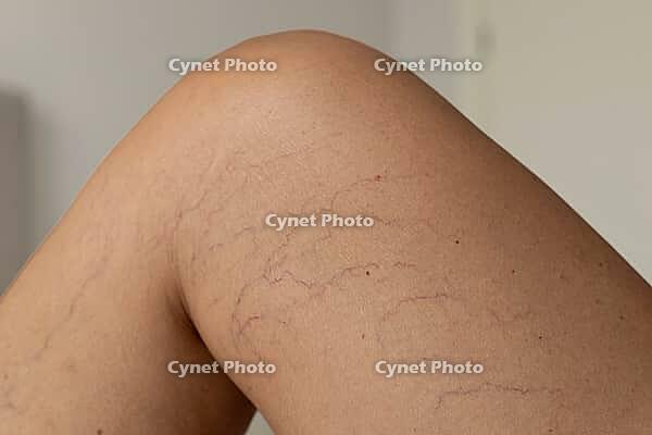 Close-up of a human leg showing varicose veins and capillaries. The skin is light brown with visible purple and blue veins on the thigh area [IBR125237509]