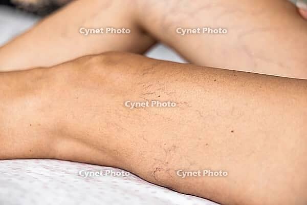 Close-up of lower leg with spider veins and superficial telangiectasia. Visible vascular changes associated with chronic venous disease, phlebology, vascular diagnostics, prevention, and medical healt [IBR125237511]