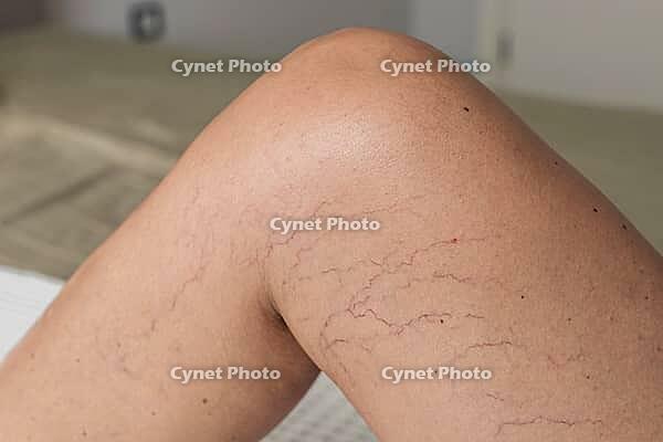 Close-up of a tanned leg showing visible varicose veins and capillaries. The skin appears smooth with a few dark lines indicating vascular issues [IBR125237513]