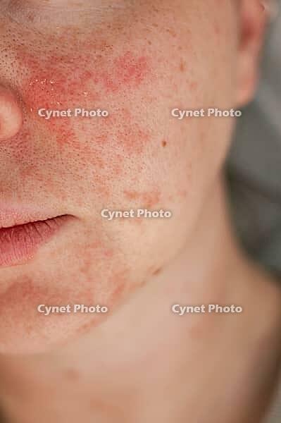 Woman no make up with red spots on her face. Health problem, skin diseases. Medicine and cosmetology concept. [IBR125237514]