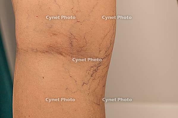 Close-up of a human leg showing varicose veins and capillaries. The skin is light brown with visible blue and purple veins. The image highlights vascular health issues [IBR125237515]