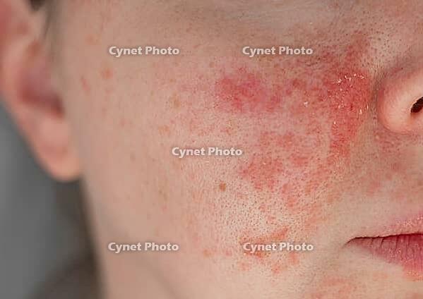 Close-up of a young womans face with visible skin irritation and redness. Inflamed, dry, and textured skin. Concept of sensitive skin, allergy, inflammation, and skincare problems [IBR125237516]