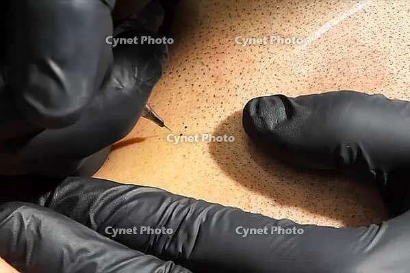 Tattooing with a needle on the scalp in the form of shaved hair. Permanent makeup for bald people to imitate hair follicles. Black medical gloves on a tattoo artist [IBR125242405]