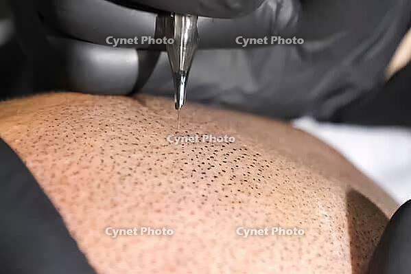 Tattooing with a needle on the scalp in the form of shaved hair. Permanent makeup for bald people to imitate hair follicles. Black medical gloves on a tattoo artist [IBR125242412]