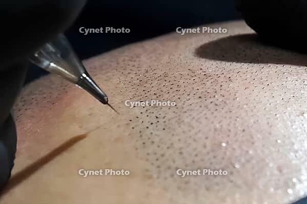 Tattooing with a needle on the scalp in the form of shaved hair. Permanent makeup for bald people to imitate hair follicles. Black medical gloves on a tattoo artist [IBR125242429]